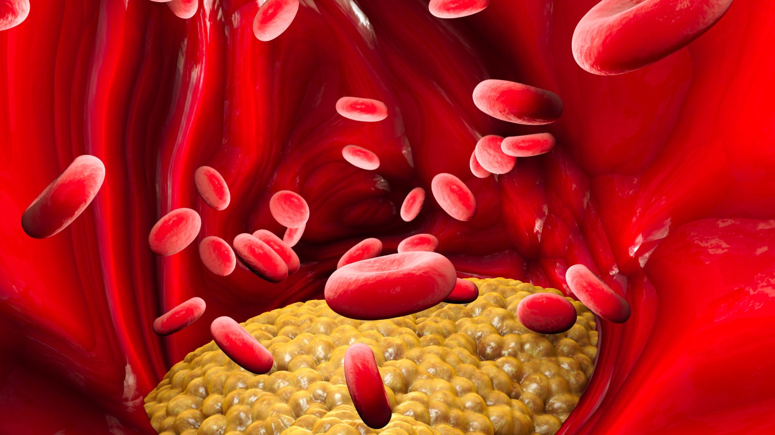 Cholesterol formation, fat, artery, vein, heart. Red blood cells, blood flow. Narrowing of a vein for fat formation, 3d render